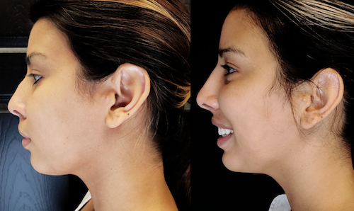 Non Surgical Nose job Filler Before After Mississauga Oakville